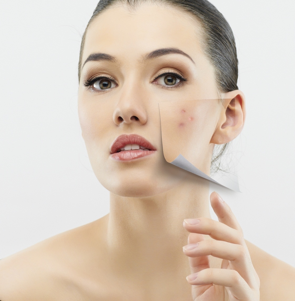 Acne tardia na mulher pede profunda investigação hormonal