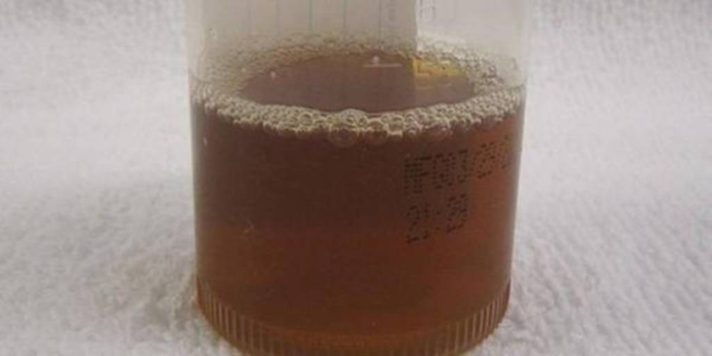 O que se sabe até agora sobre a doença misteriosa da urina preta