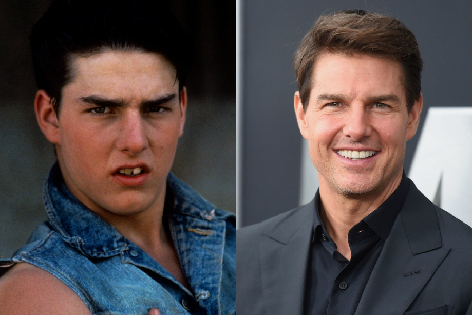 O “antes e depois” dos dentes dos famosos