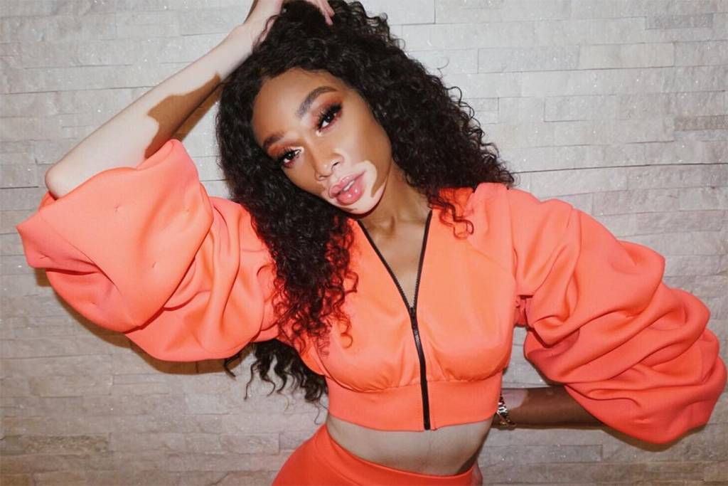 Modelo pede que imprensa pare de falar que ela sofre de vitiligo