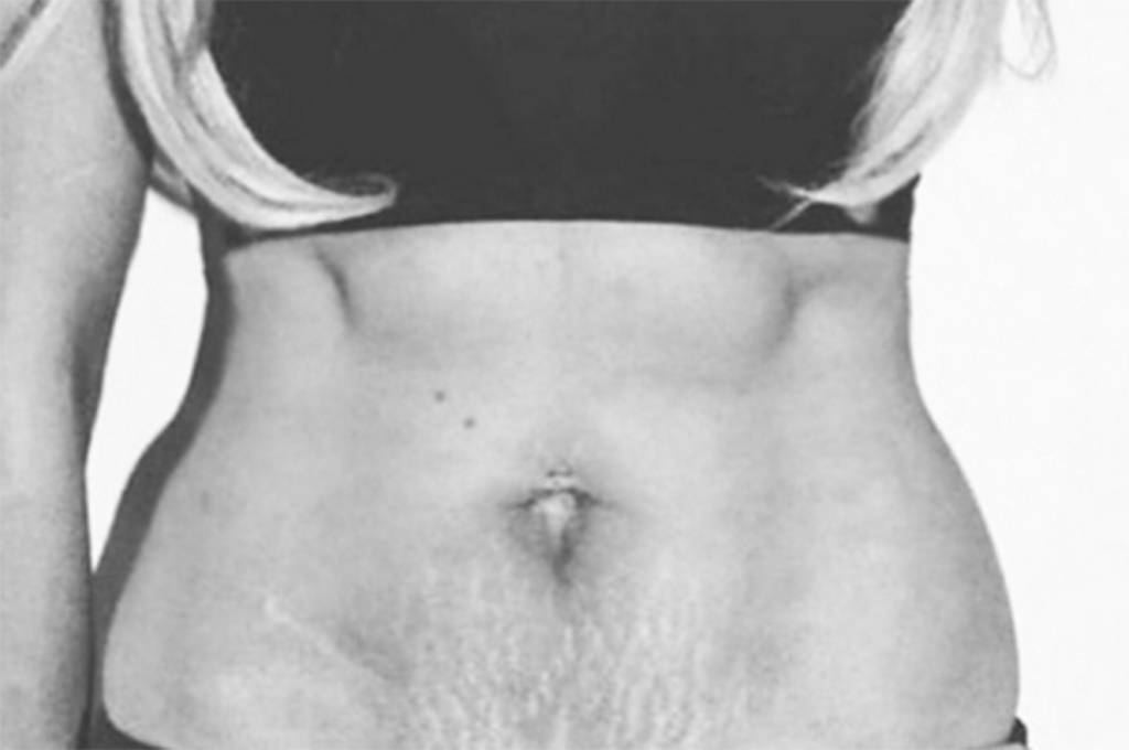 Blogueira revela como superou trauma causado por estrias da gravidez