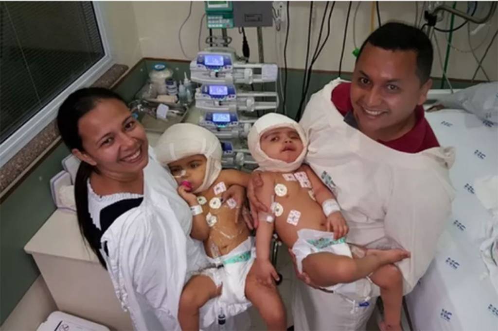 Gêmeas siamesas brasileiras passam por cirurgia de separação