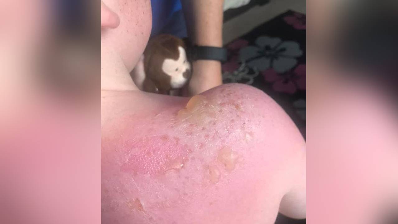 Garoto tem queimadura solar mesmo usando protetor fator 50