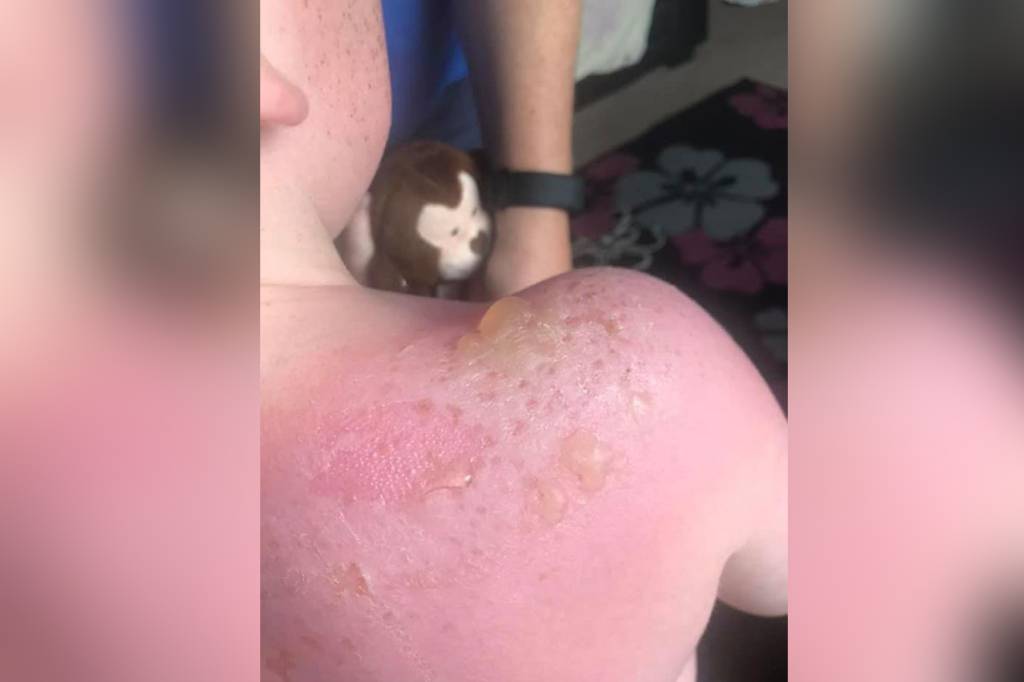 Mãe faz alerta após filho ter queimadura solar mesmo usando protetor