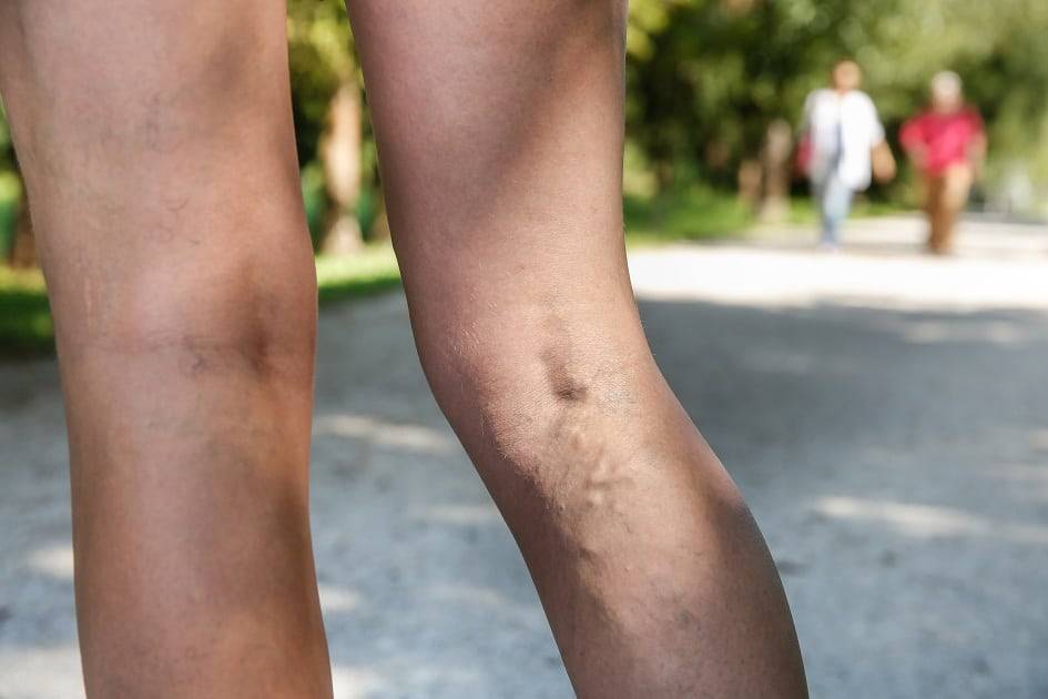 Saiba como evitar trombose após uma cirurgia
