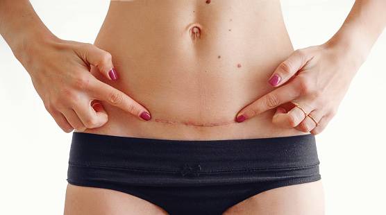 Os melhores tratamentos para cicatrizes