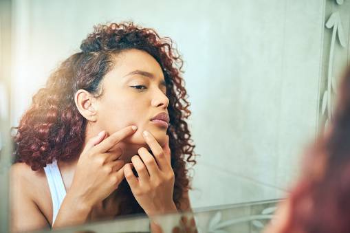 Mitos e verdades sobre acne e chocolate, segundo dermatologistas