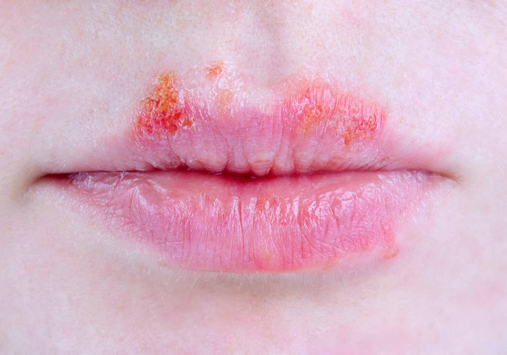 Não confunda herpes zoster com herpes simples