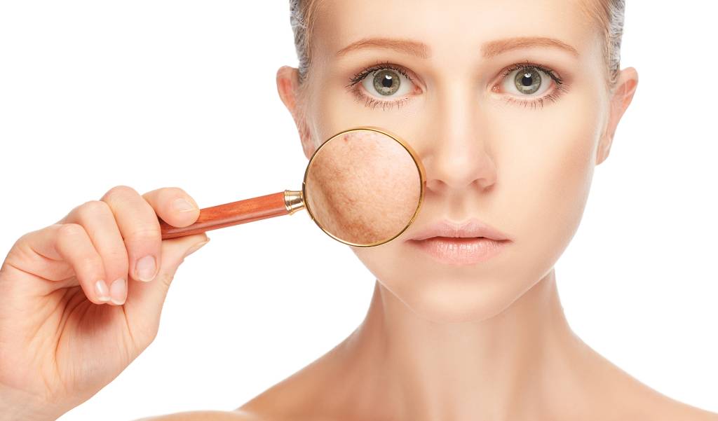 Cisteamina e microagulhamento: o que há de novo no tratamento para melasma