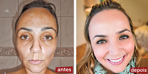 Saiba como usar ácidos para tratar acne, manchas  e rugas