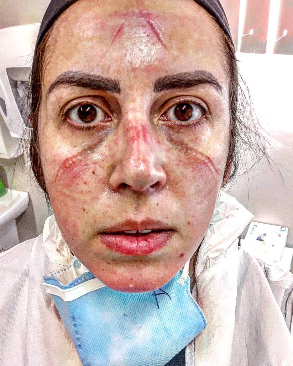 “Respiro coronavírus 24h por dia”, diz enfermeira de Pelotas