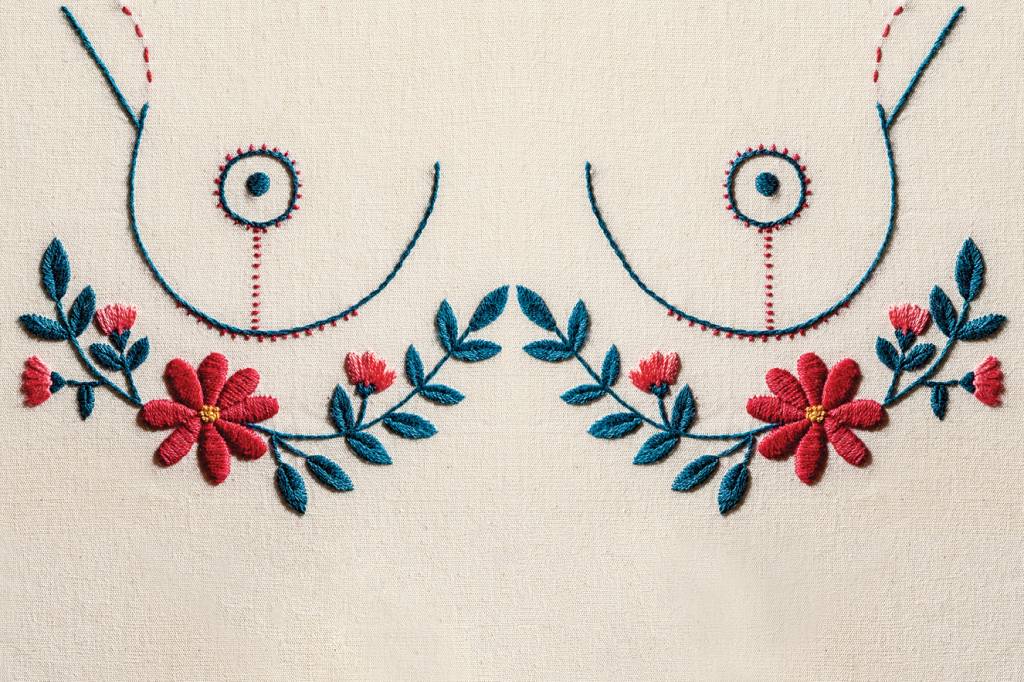 Cresce número de mulheres que optam pelo explante das próteses de silicone