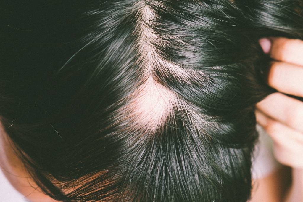 Man with alopecia areata on head, Spot Baldness, Hair fall problem