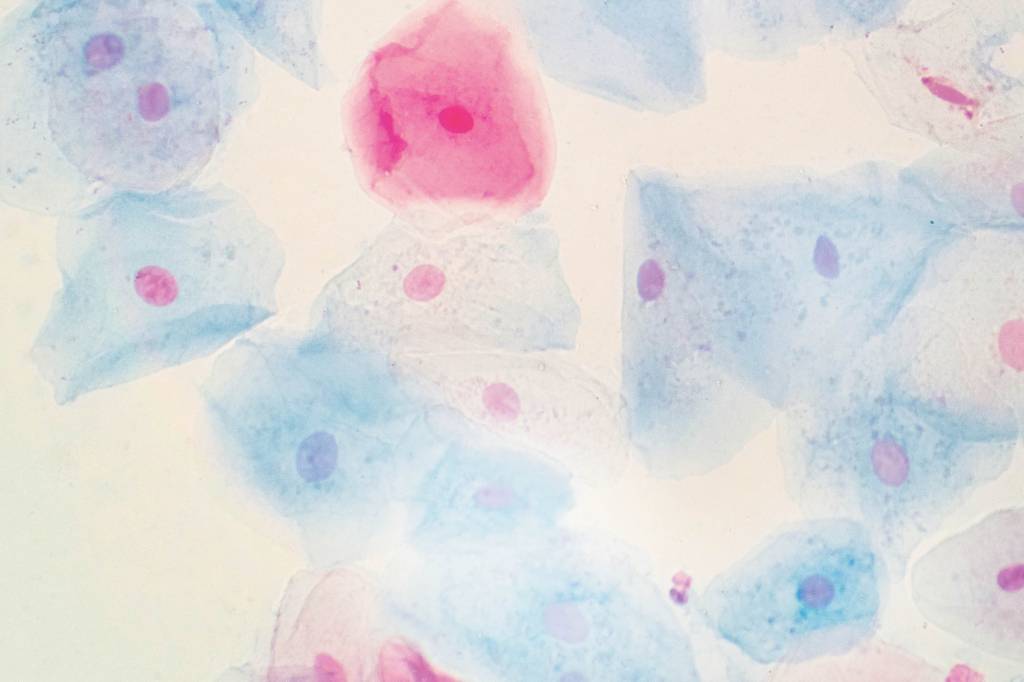 Na hora certa: quando realmente fazer o papanicolau