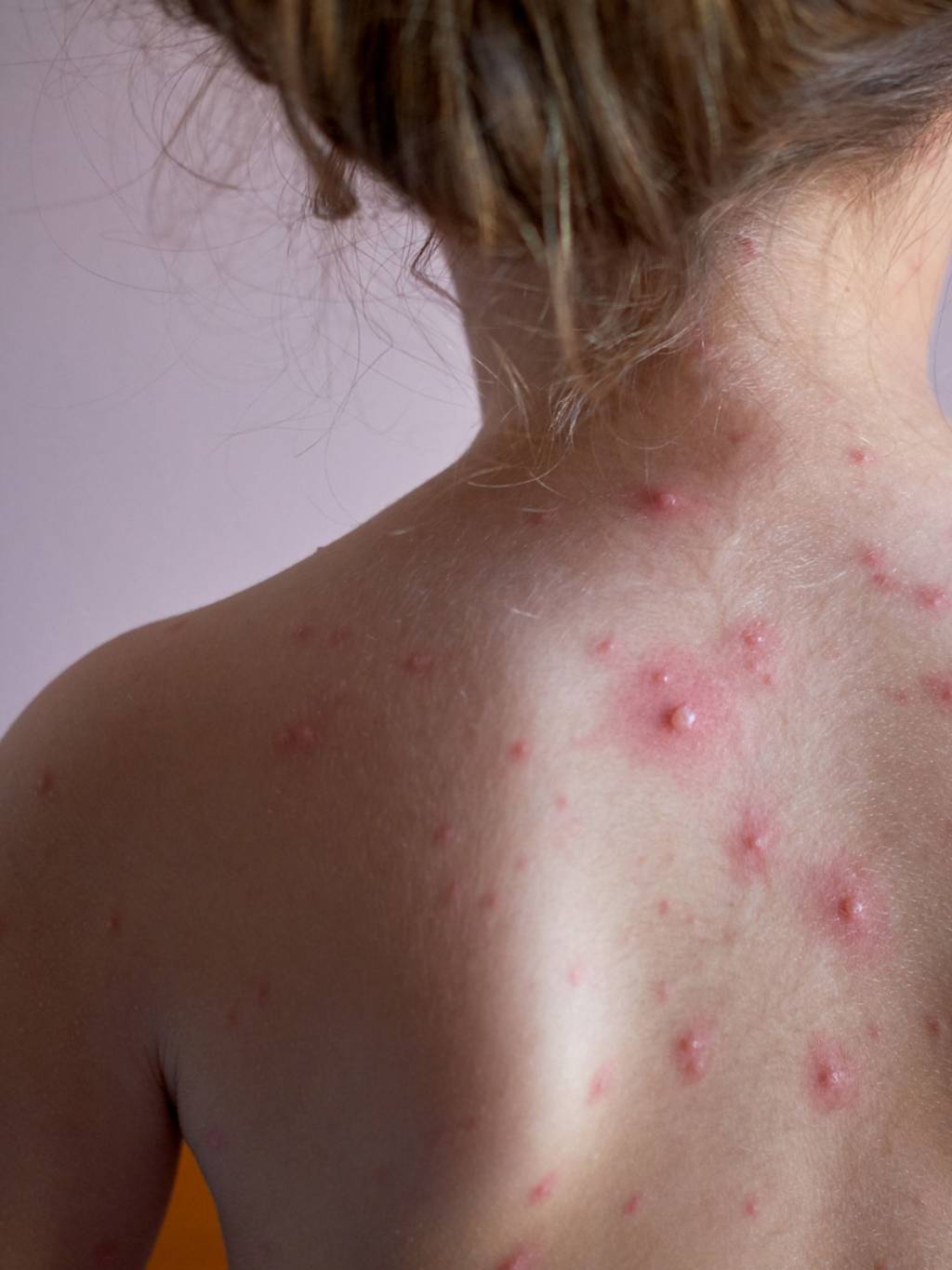 Número de casos de catapora cresce 65% em São Paulo