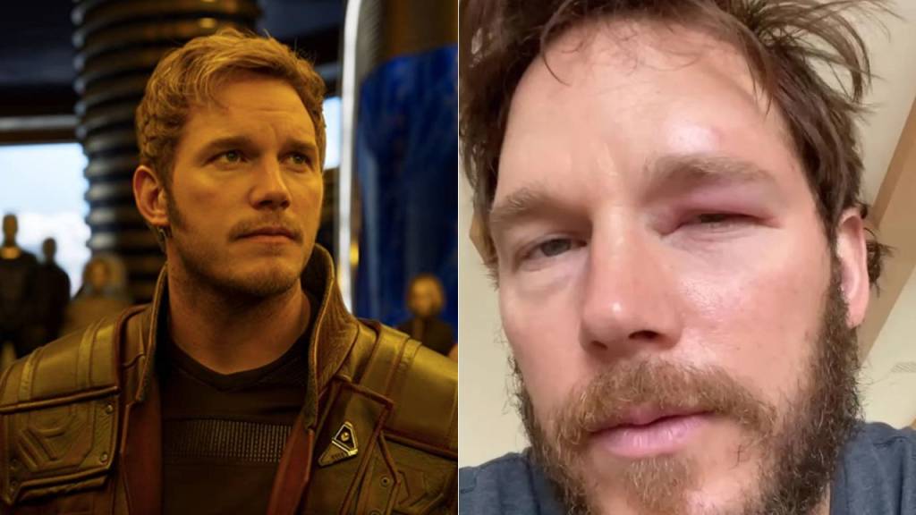 Chris Pratt recebe picada de abelha no olho e mostra resultado na internet