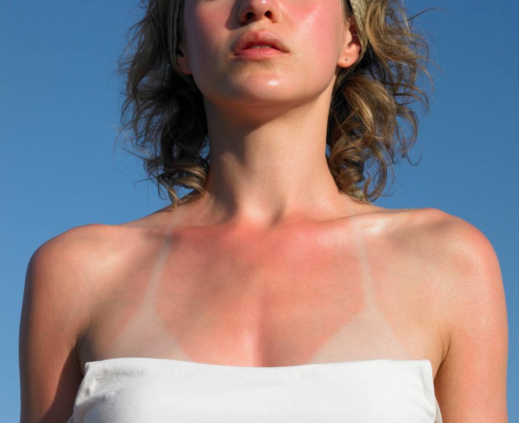 O que é bom para queimadura de sol? Dermatologista responde