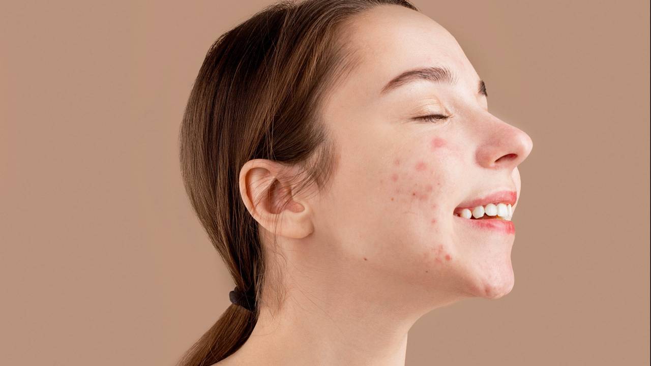 Mulher com acne no rosto
