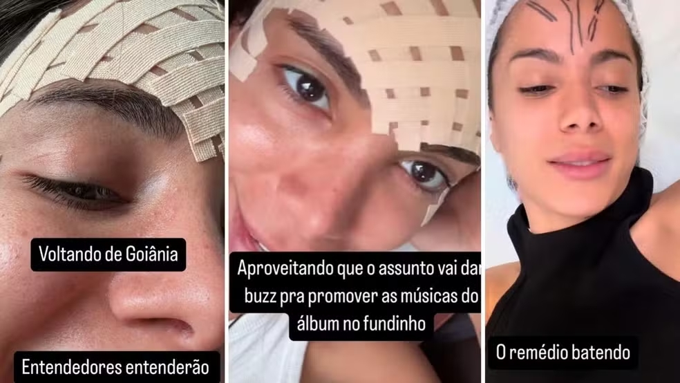 Veia da testa da Anitta: entenda o procedimento estético para remover o vaso sanguíneo