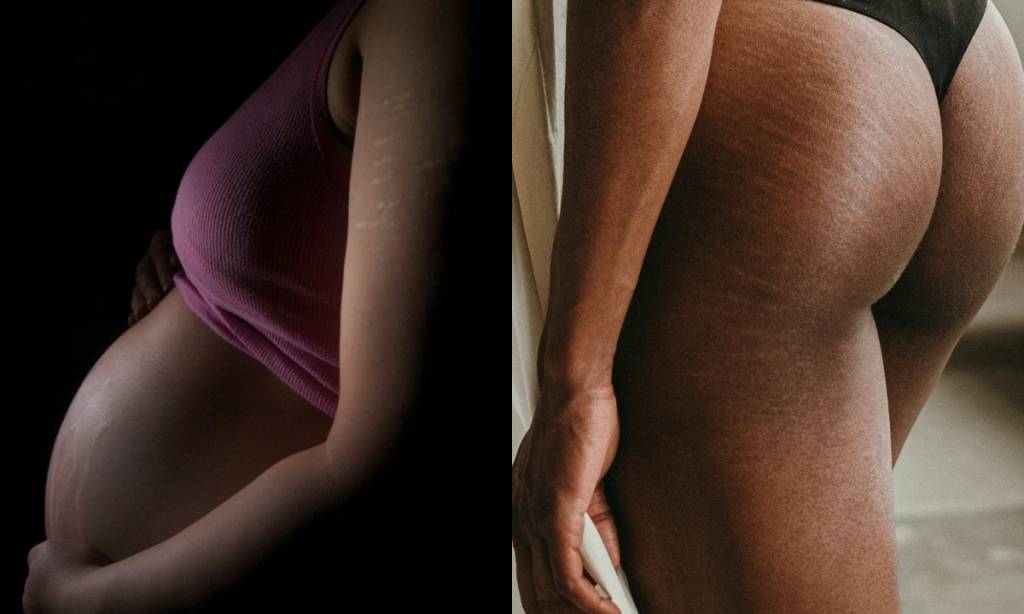 Como evitar estrias na gravidez: 5 dicas infalíveis