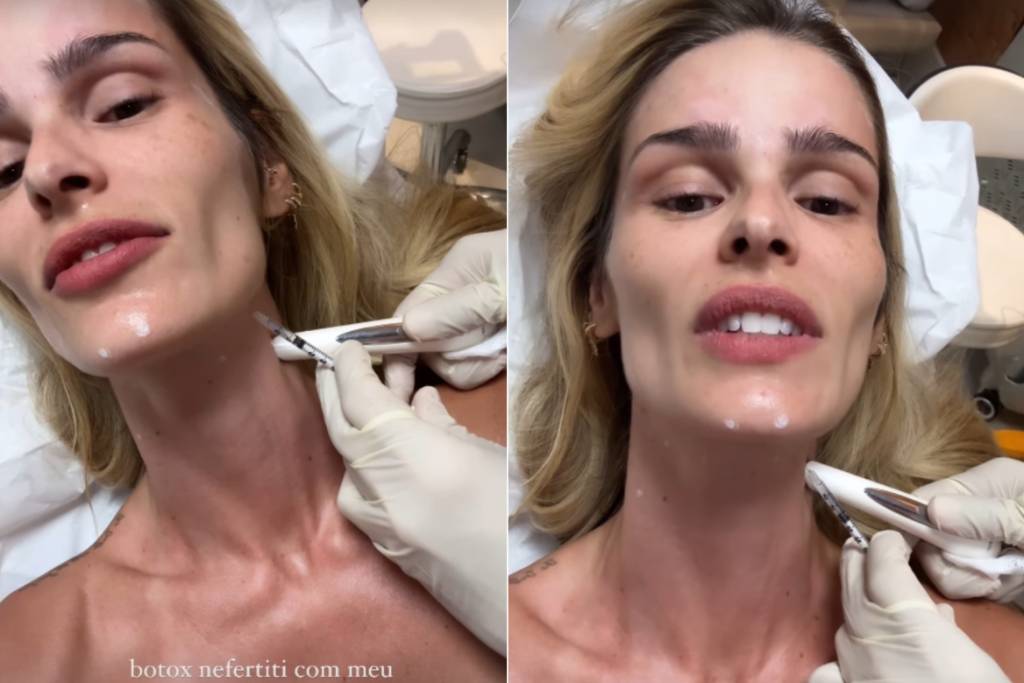 O que é o Botox Nefertiti, que Yasmin Brunet fez?