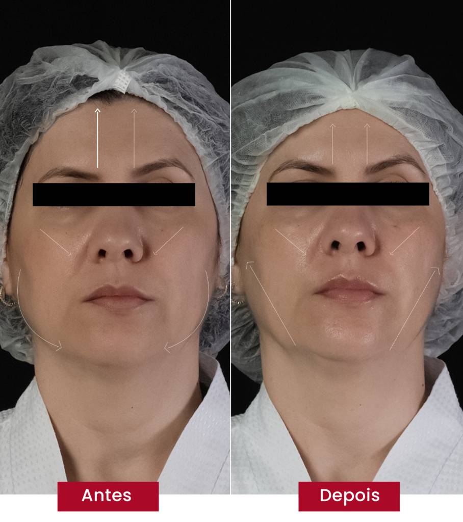 glass-skin-coreana (4) Marcas de expressão também são suavizadas com glass skin coreana