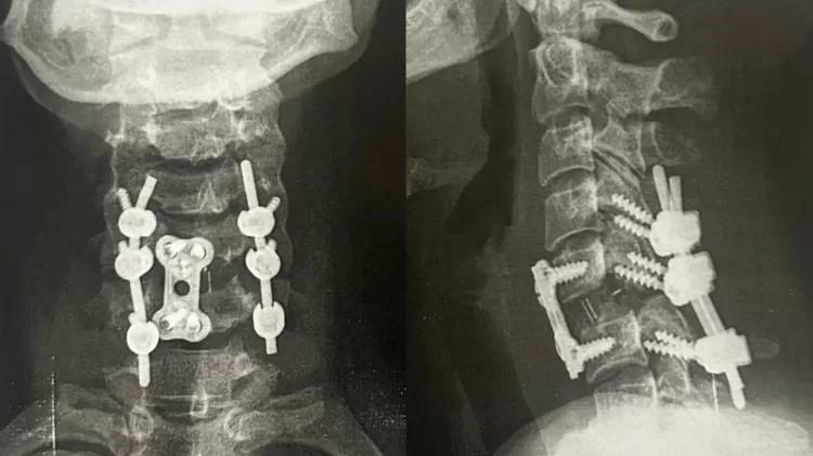 Lindalva precisou fazer uma cirurgia para colocar as vértebras c5 e c6 no lugar certo