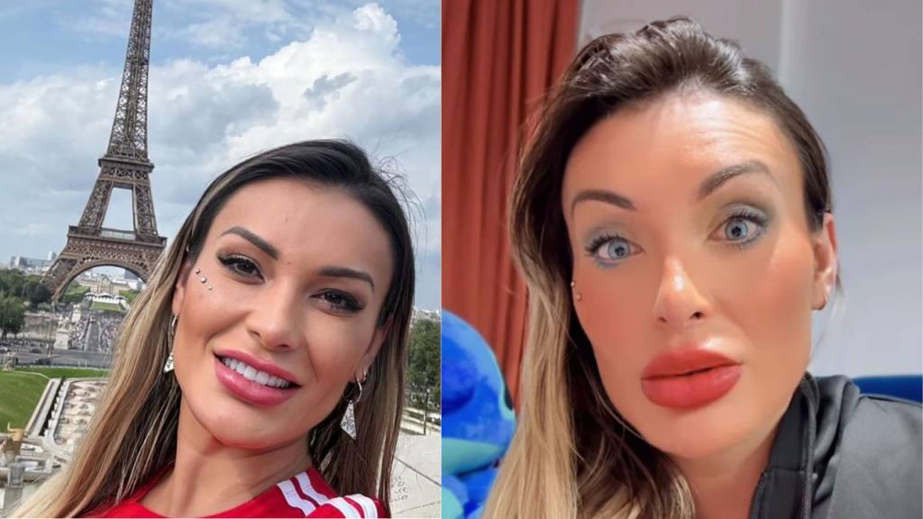 ceratopigmentação-andressa Imagem mostra antes e depois de Andressa Urach após cirurgia nos olhos.