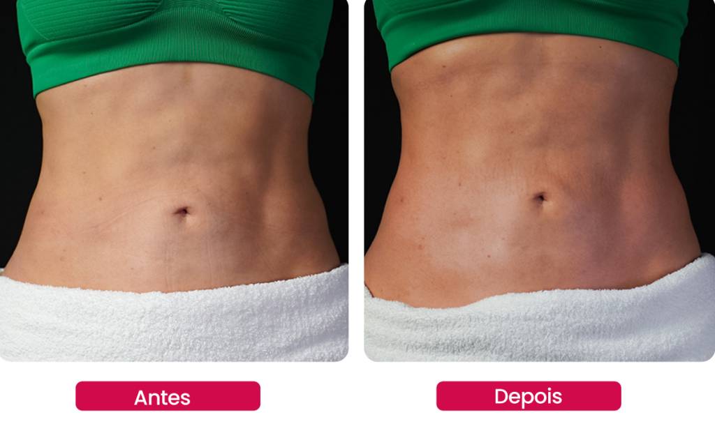 microagulhamento-invisivel-antes-depois (2) Micro-agulhamento biológico busca reduzir os efeitos que a perda de peso de forma abrupta causa na pele do corpo inteiro, como derretimento facial, bumbum caído, flacidez nas pernas e flacidez muscular