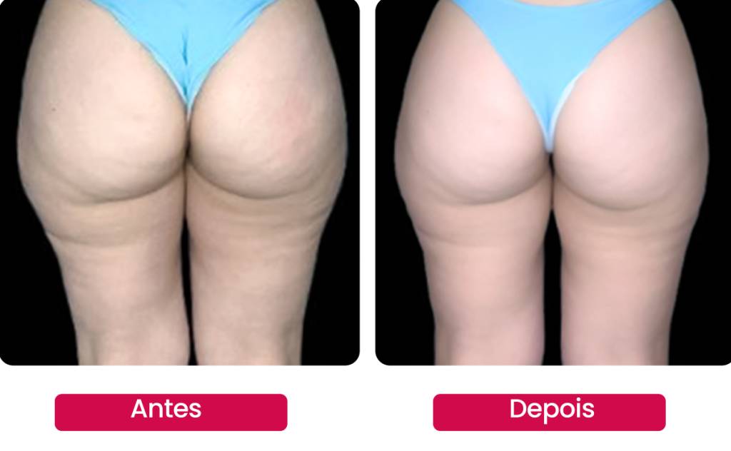 microagulhamento-invisivel-antes-depois Micro-agulhmento biológioco promete bons resultados em reduzir a flacidez no corpo
