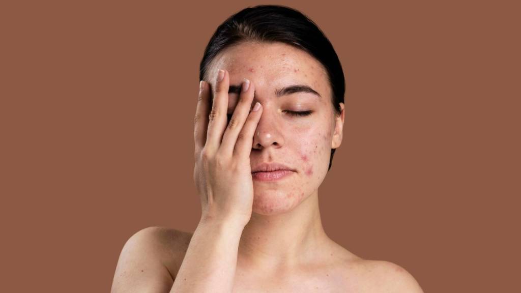 Acne na vida adulta: por que as espinhas voltam aos 30, 35 ou 40 anos?