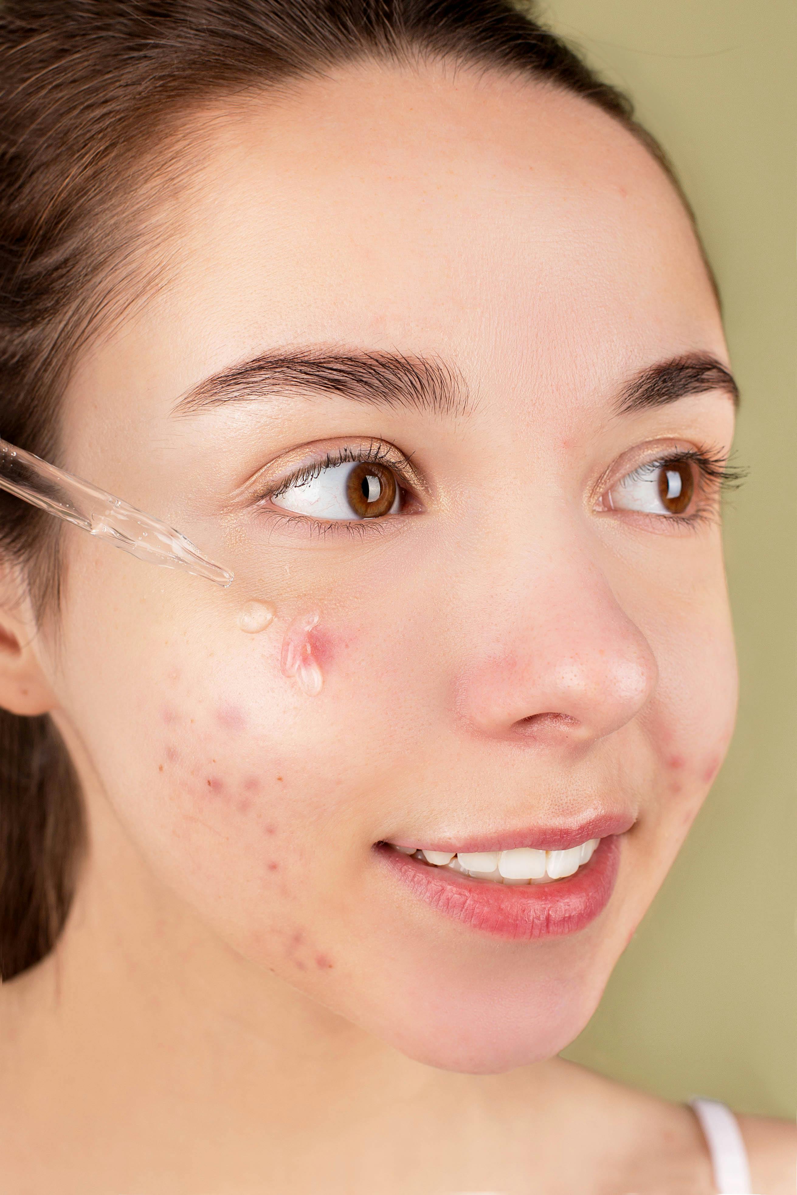 Mulher aplicando &oacute;leo no rosto com acne