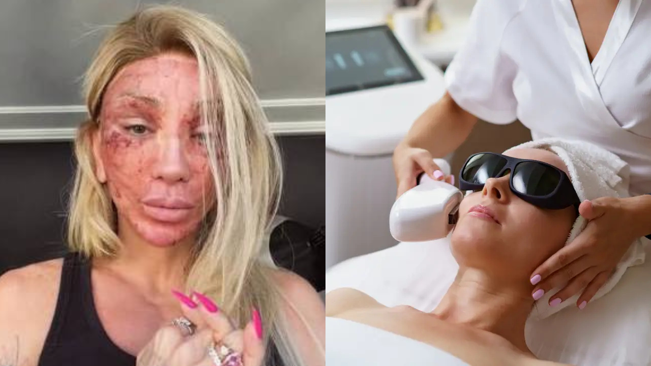À esquerda, uma mulher loira com o rosto avermelhado e inchado, parecendo queimado. À direita, uma mulher deitada com óculos de proteção e toalha na cabeça, recebendo um tratamento facial com aparelho de luz pulsada de uma profissional