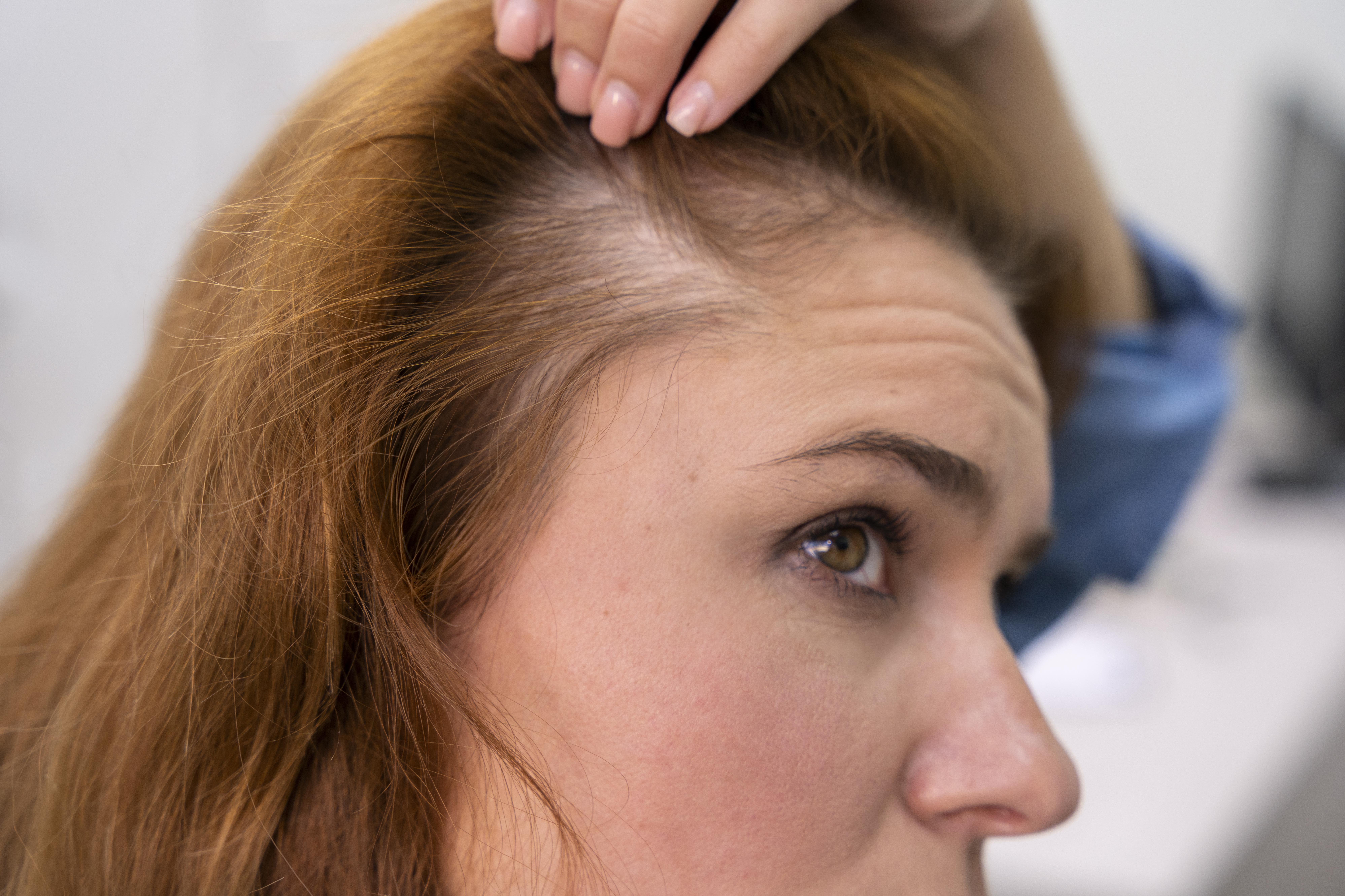 Mulher de cabelo ruivo, com a mão direita levantando uma mecha para mostrar uma área com queda de cabelo no couro cabeludo